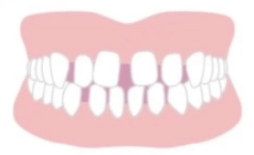 空隙歯列（すきっ歯）の適応症例イメージ