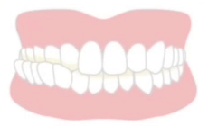 交叉咬合（噛み合わせのずれ）の適応症例イメージ