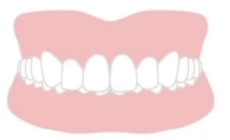 過蓋咬合（オーバーバイト）の適応症例イメージ