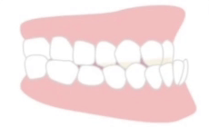 下顎前突（受け口）の適応症例イメージ