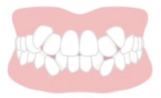 叢生（乱ぐい歯）の適応症例イメージ