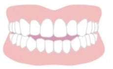 開咬（オープンバイト）の適応症例イメージ