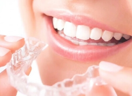 女性の笑顔とマウスピース